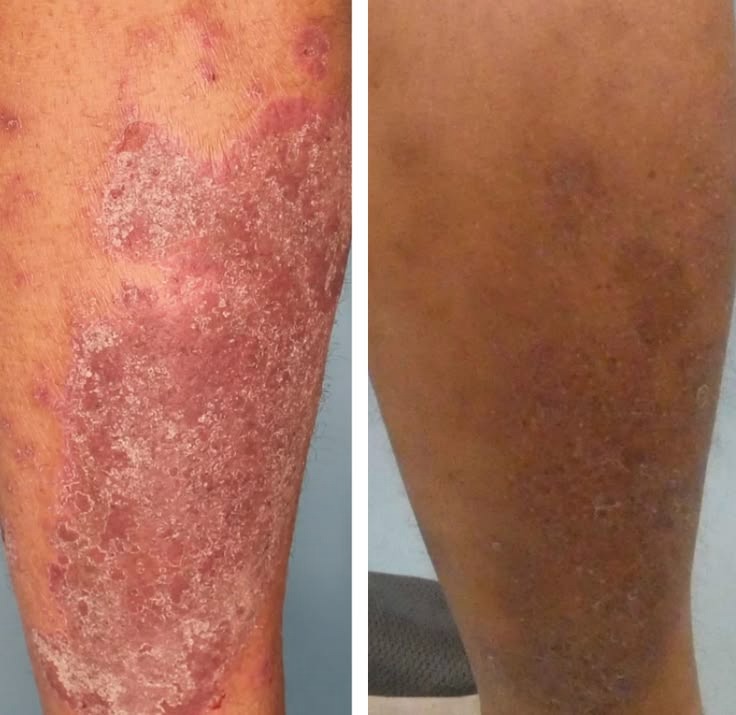 Patient treatment result