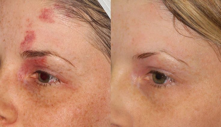 Patient treatment result